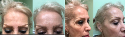 Botox before and after photo