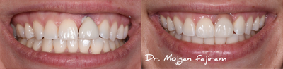Dental Crown before and after photo