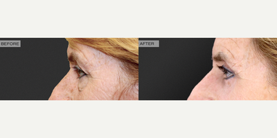 Eyelid Surgery before and after photo