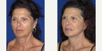 Facelift before and after photo