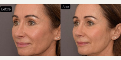 Revision Rhinoplasty before and after photo