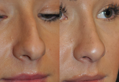 Rhinoplasty before and after photo