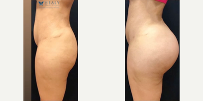 Butt Augmentation before and after photo