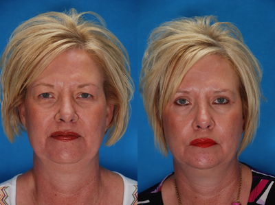 Eyelid Surgery before and after photo