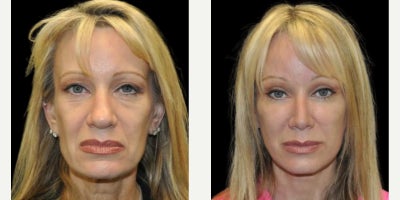 Facelift before and after photo