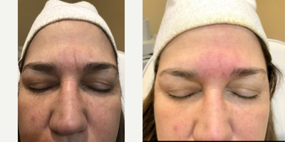 Juvederm before and after photo