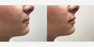 Volbella before and after photo