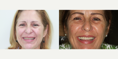 Dental Implants before and after photo