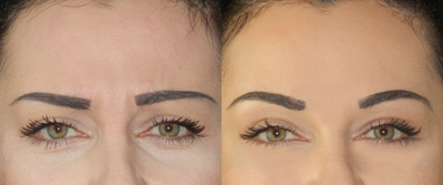 Botox before and after photo