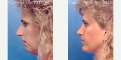 Chin Implant before and after photo