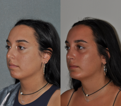 Chin Implant before and after photo