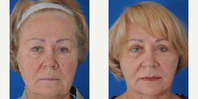 Eyelid Surgery before and after photo