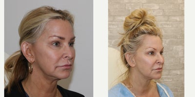 Juvederm before and after photo