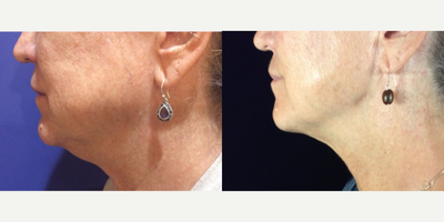 Kybella before and after photo
