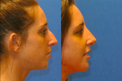Rhinoplasty before and after photo