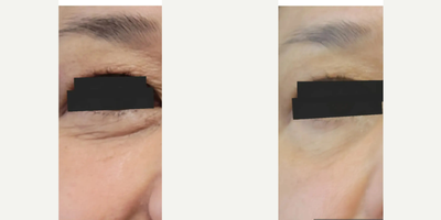 Skin Rejuvenation before and after photo