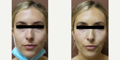 Eyelid Surgery before and after photo
