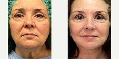 Facelift before and after photo