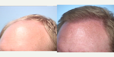 Hair Transplant before and after photo