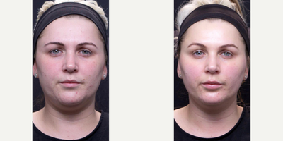 Lip Fillers before and after photo