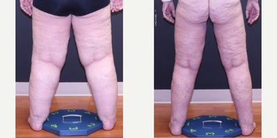 Lipedema Surgery before and after photo