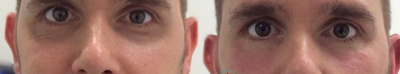 Liquid Facelift before and after photo