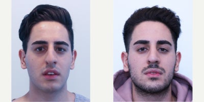 Rhinoplasty before and after photo