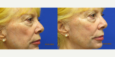 Voluma before and after photo