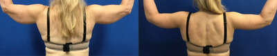 Arm Lift before and after photo