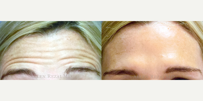Botox before and after photo