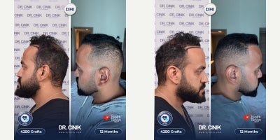 DHI Hair Transplant before and after photo