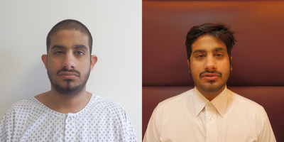 Ear Surgery before and after photo