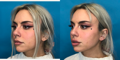 Lip Fillers before and after photo