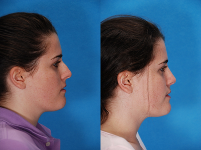 Rhinoplasty before and after photo