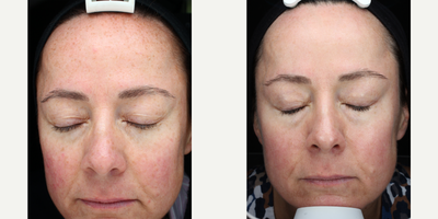 Skin Rejuvenation before and after photo