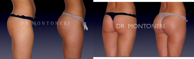 Butt Implants before and after photo