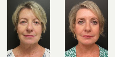 Facelift before and after photo