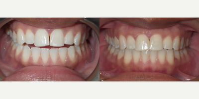 Invisalign before and after photo