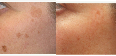 Laser Resurfacing before and after photo