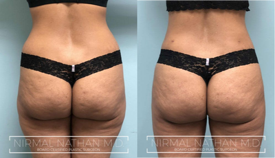 Liposuction before and after photo