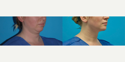 Liposuction before and after photo