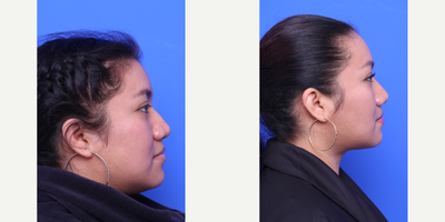 Cheek Augmentation before and after photo