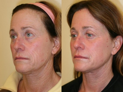 Fractional Laser before and after photo