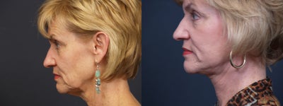 Neck Lift before and after photo