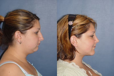 Chin Implant before and after photo
