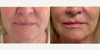 Dermal Fillers before and after photo
