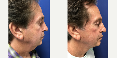 Facelift before and after photo