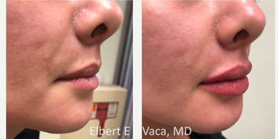 Lip Fillers before and after photo