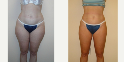 Liposuction before and after photo