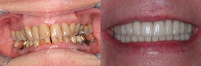 Smile Makeover before and after photo